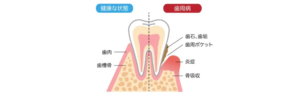 歯周病とは
