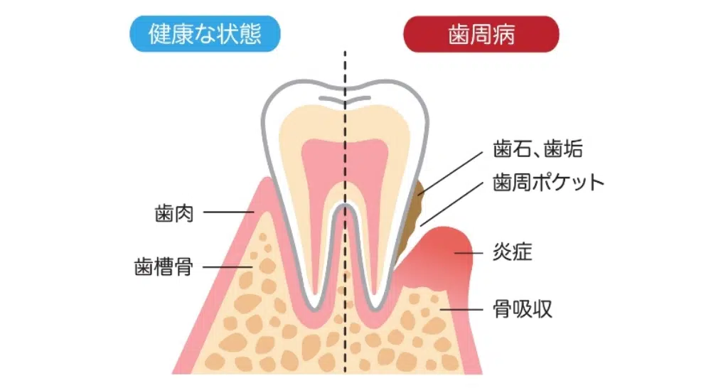 歯周病とは