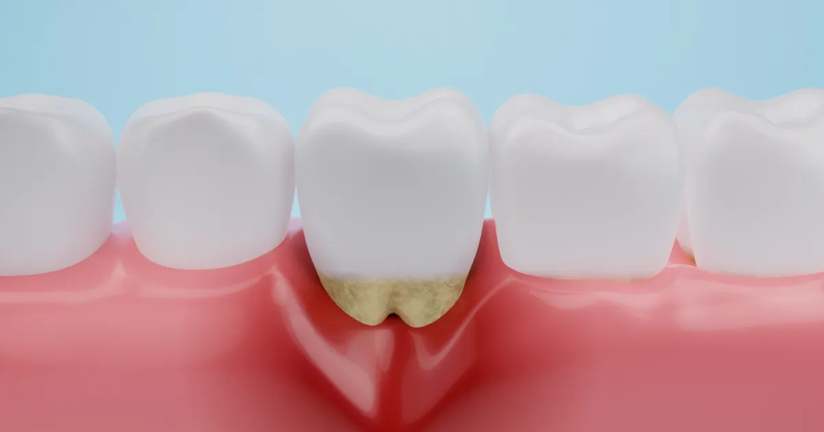 periodontal_key.webp