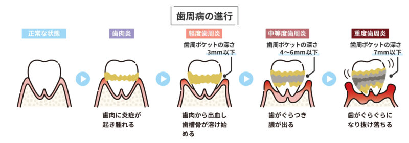 歯周病の進行段階のイラスト